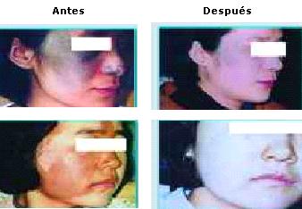 tratamiento de manchas despigmentacion acne
